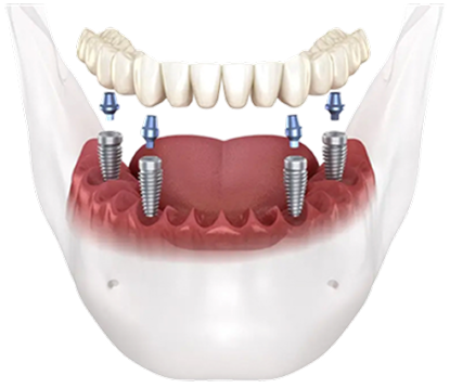 All on 4 implant bridge and posts